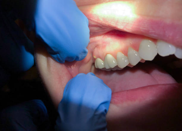 Best Emergency Wisdom Teeth Removal in Wakefield, MI